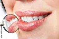clear tooth gem