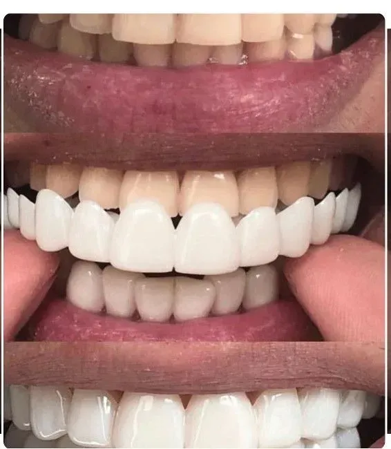 snap on veneer