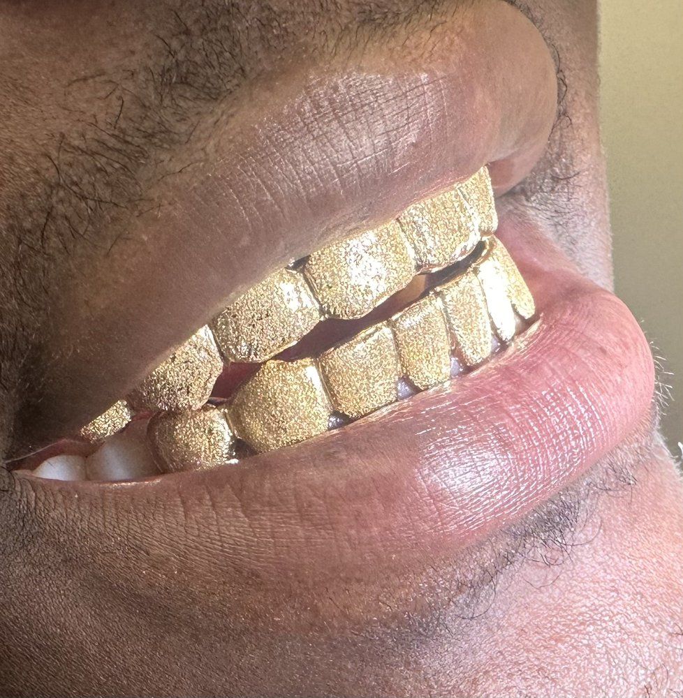 permanent gold teeth 