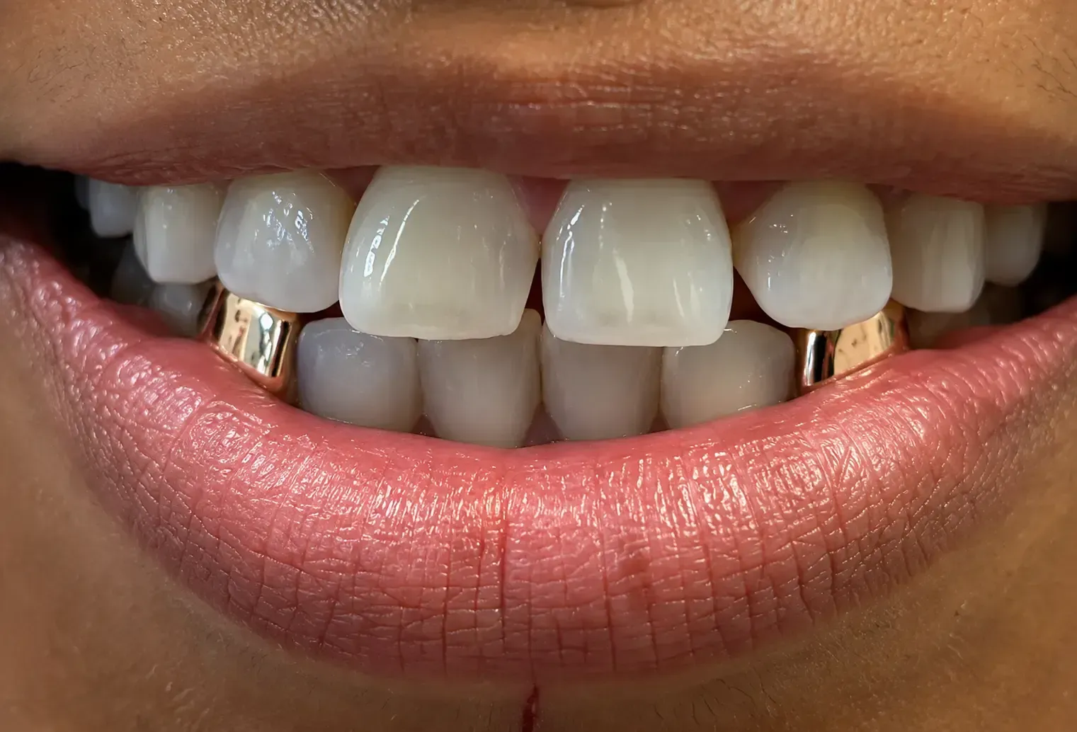 silver tooth caps 