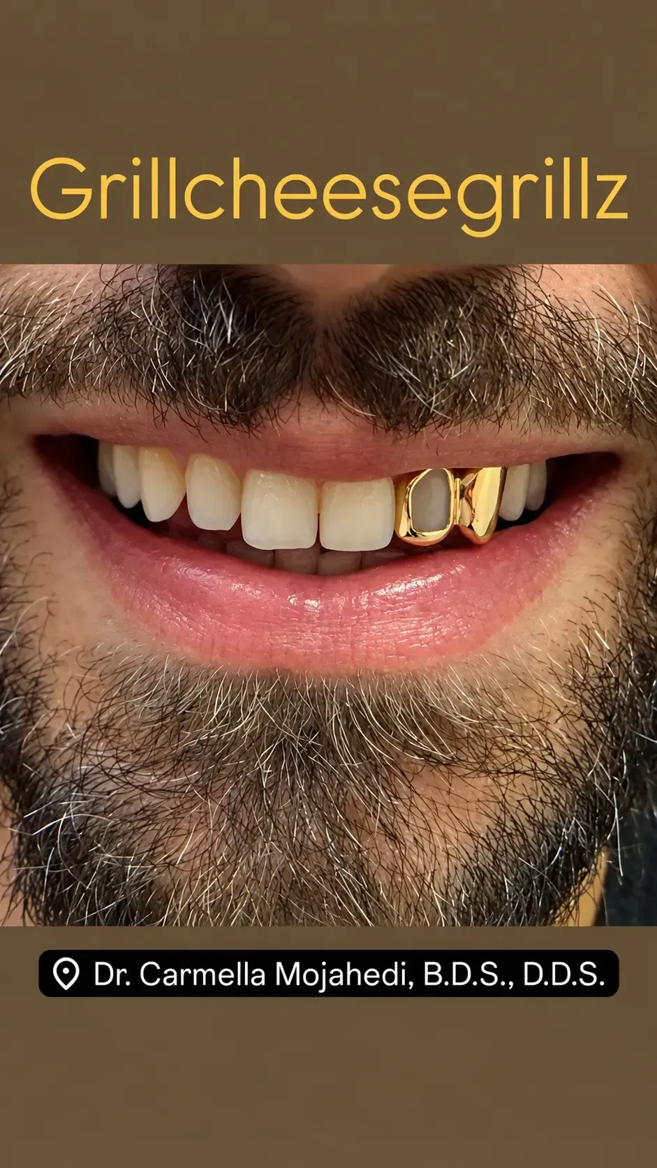 gold tooth caps