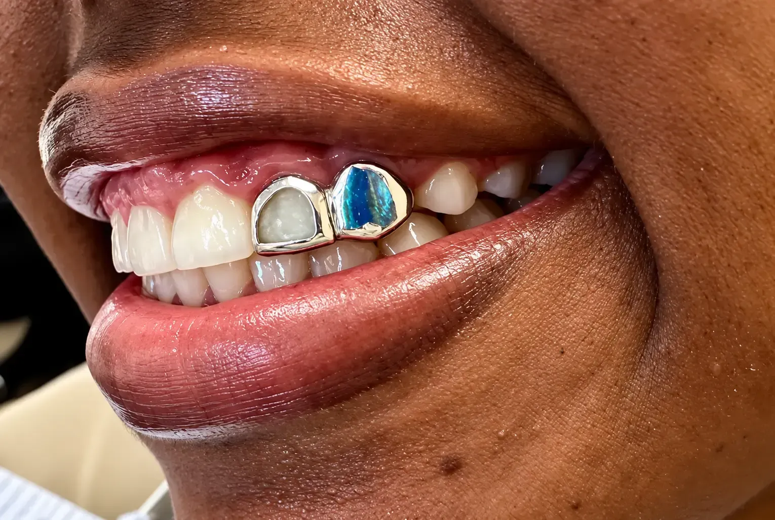 silver tooth cap with gem