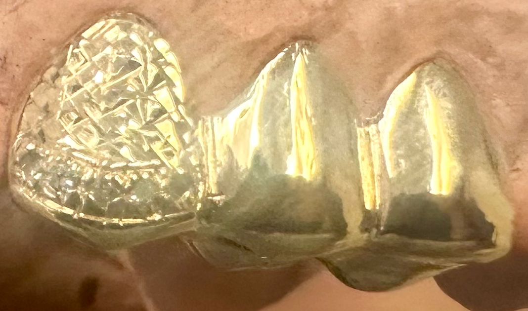 Custom gold grillz Sacramento - textured diamond-cut design on front teeth
