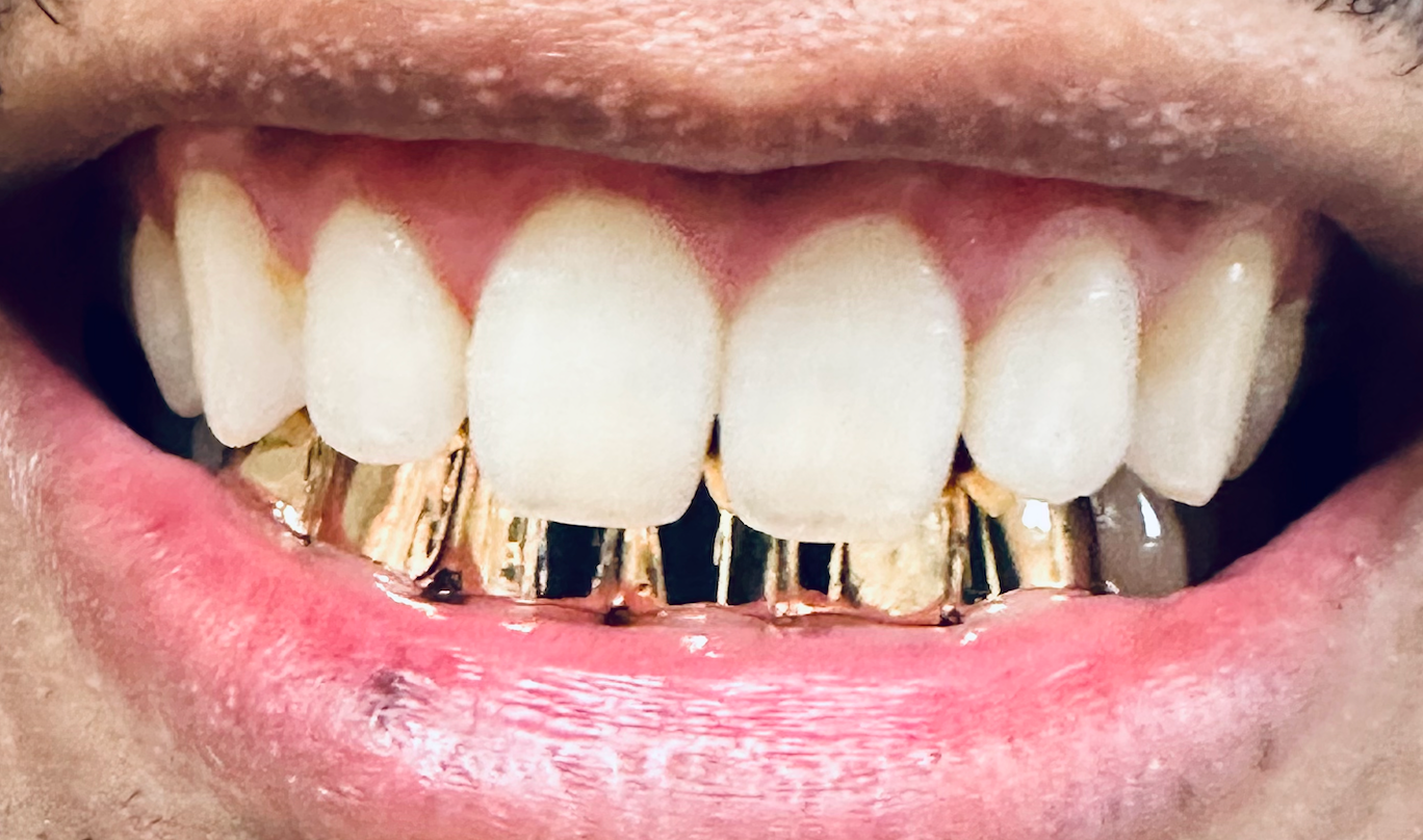 A smiling mouth with white teeth and permanent gold grillz on the lower front teeth from Grill Cheese Grillz