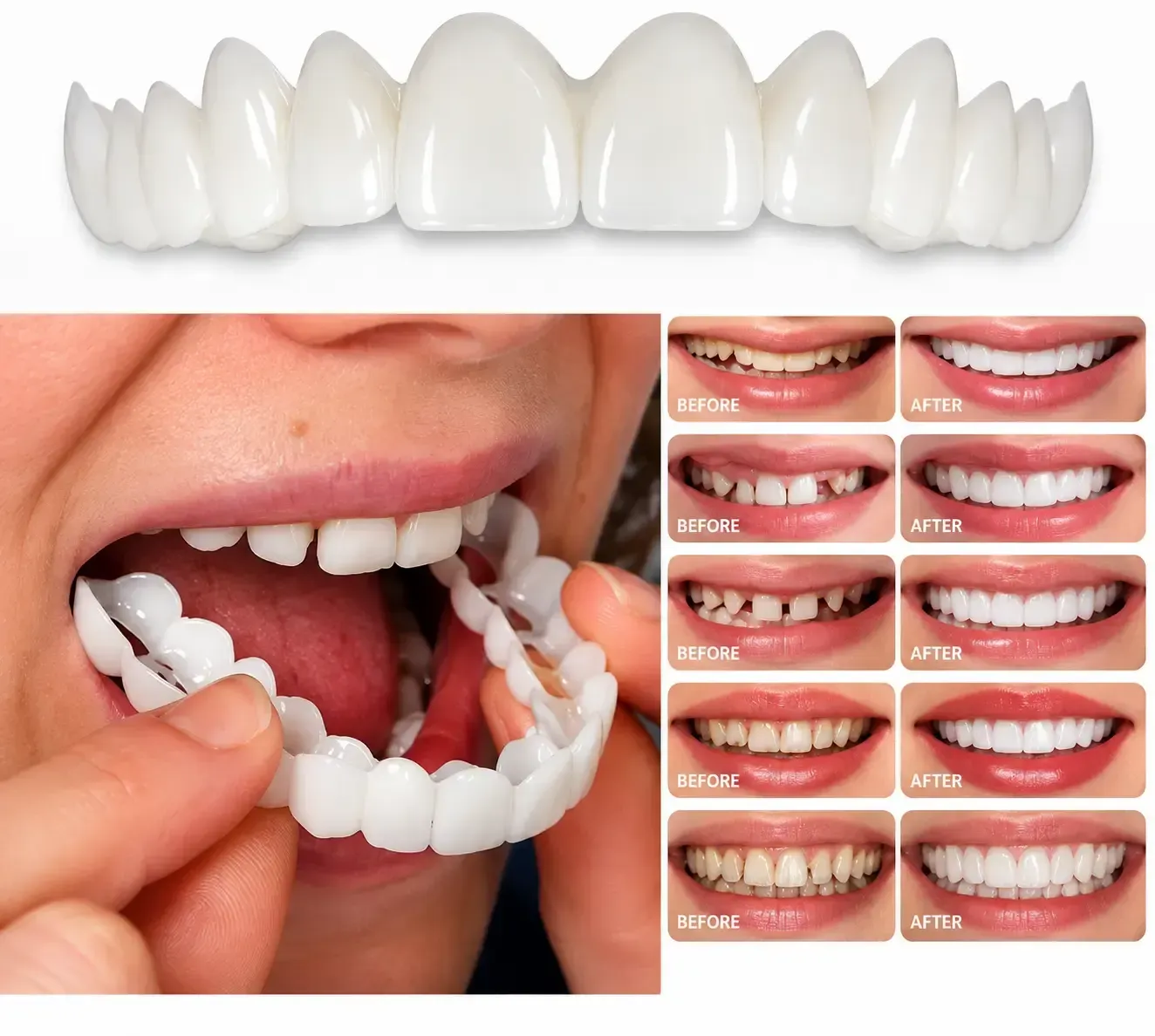before & after of multiple snap on veneers in collage