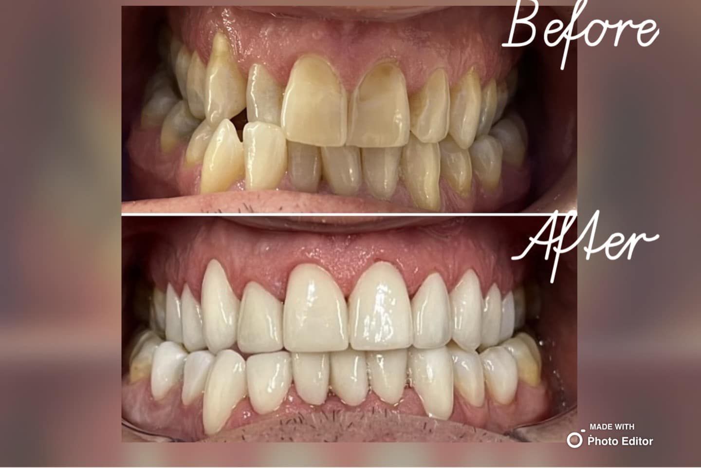 A Before and After Picture of A Person's Teeth — Steve King Dental Group in Kuranda, QLD