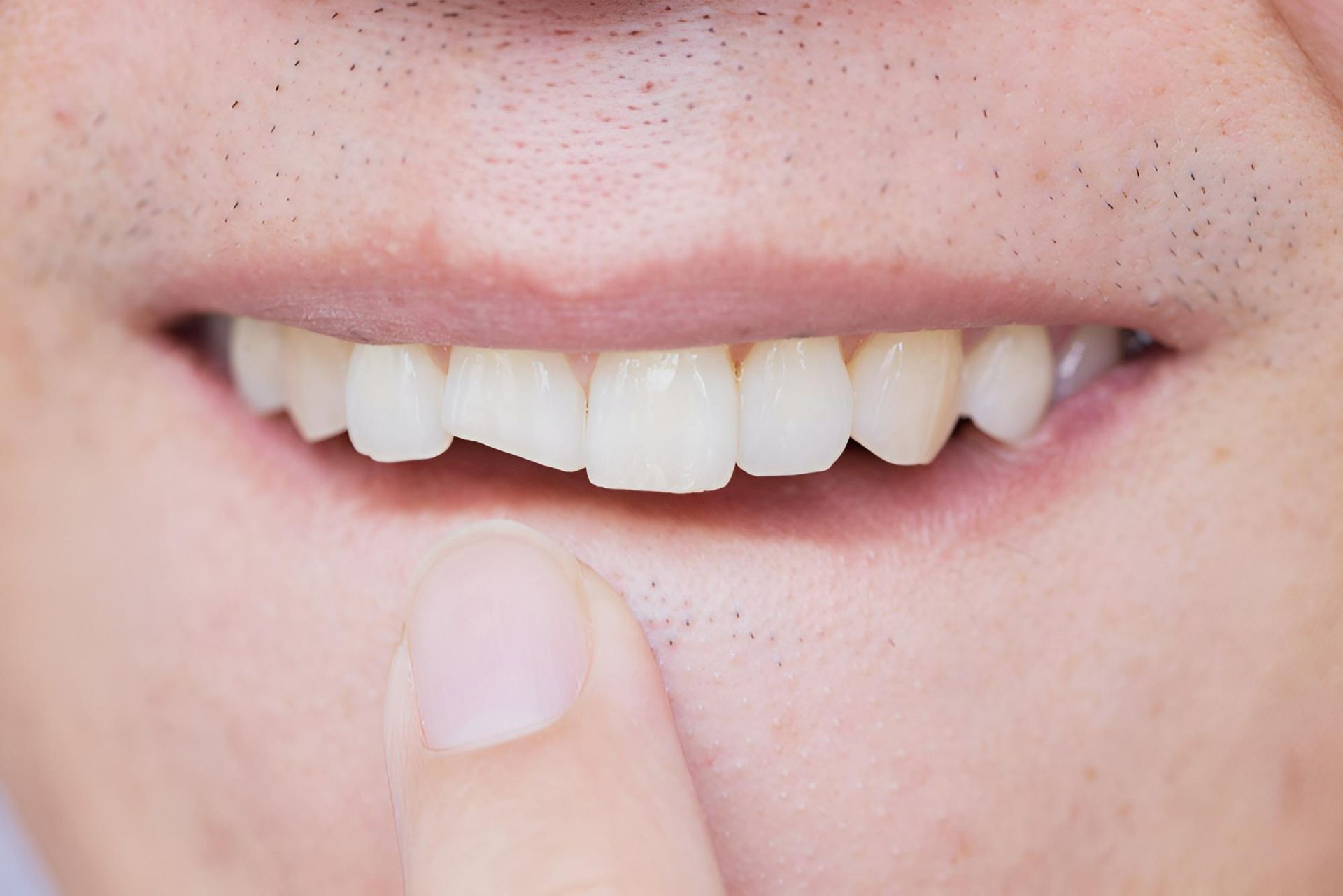 A Close up Of a Man's Mouth with A Broken Tooth — Steve King Dental Group in Manunda, QLD