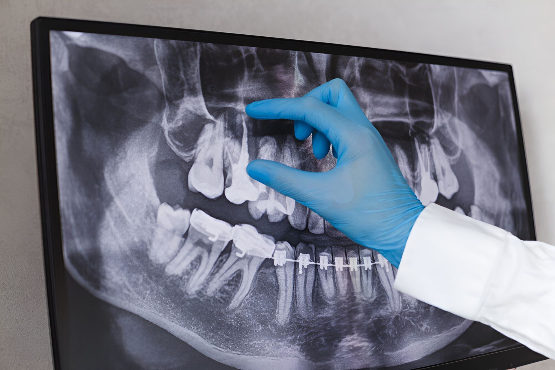A Dentist Is Looking at An X-Ray of A Person's Teeth — Steve King Dental Group in Mossman, QLD
