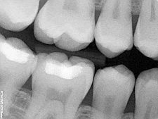 A close up of a person 's teeth in a black and white photo.