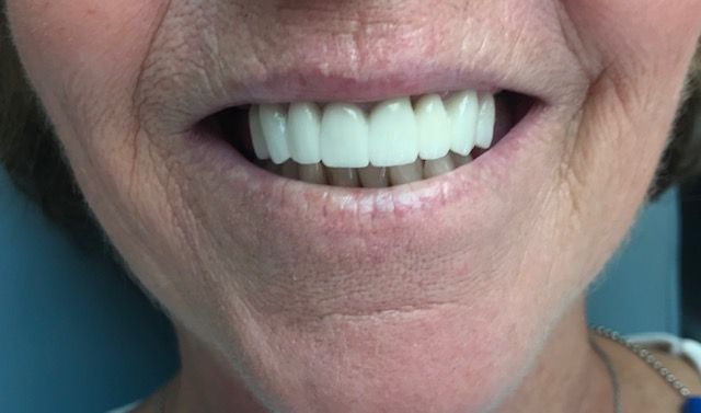 A close up of a woman 's mouth with white teeth.