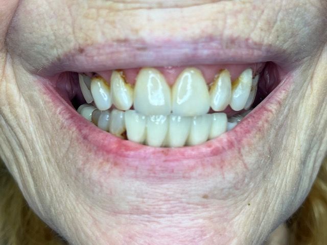 Close-up of a smiling mouth, showing teeth. Gums are slightly red, and teeth are yellowed.