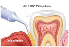An illustration of a tooth being treated with arestin microspheres.