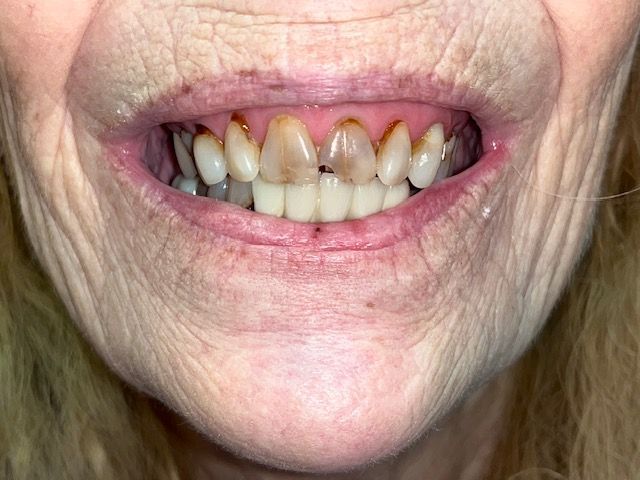 Close-up of a person's mouth, showing discolored and damaged teeth. Skin around mouth has wrinkles.