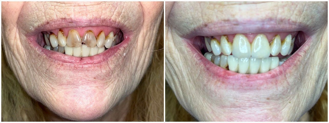 Side-by-side comparison of teeth. The before image shows stained teeth. The after shows bright, white teeth.