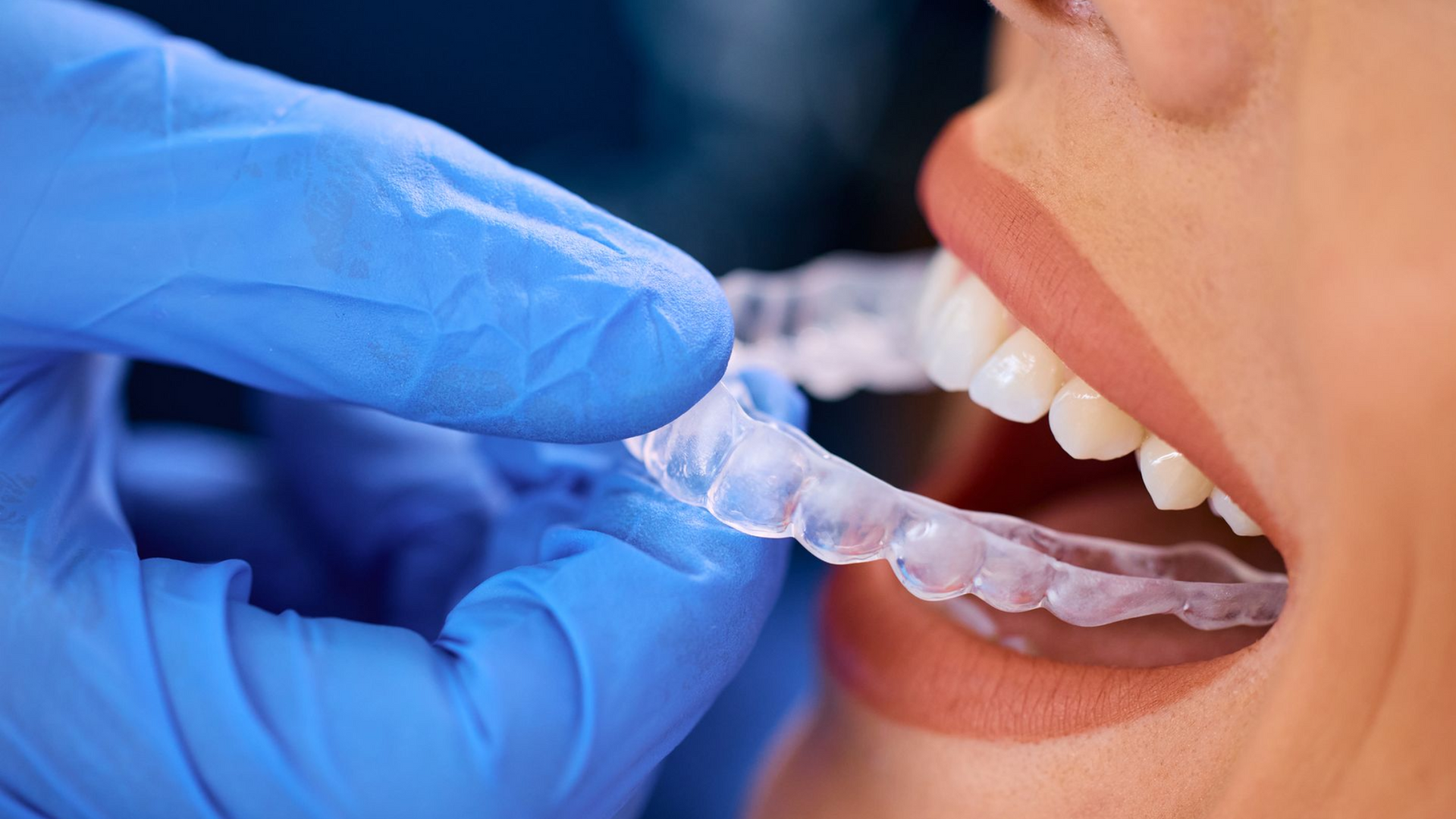 Gloved hand inserts clear aligner into patient's open mouth, showing healthy teeth.