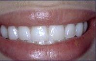 Close-up of a person's bright white smile, lips slightly parted, showing teeth and gums.