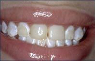A before and after picture of a person 's teeth.