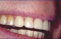 A before and after picture of a person 's teeth.