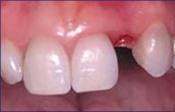 A before and after picture of a person 's teeth.