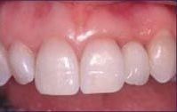 Close-up view of a person's upper front teeth, appearing bright white against pink gums.