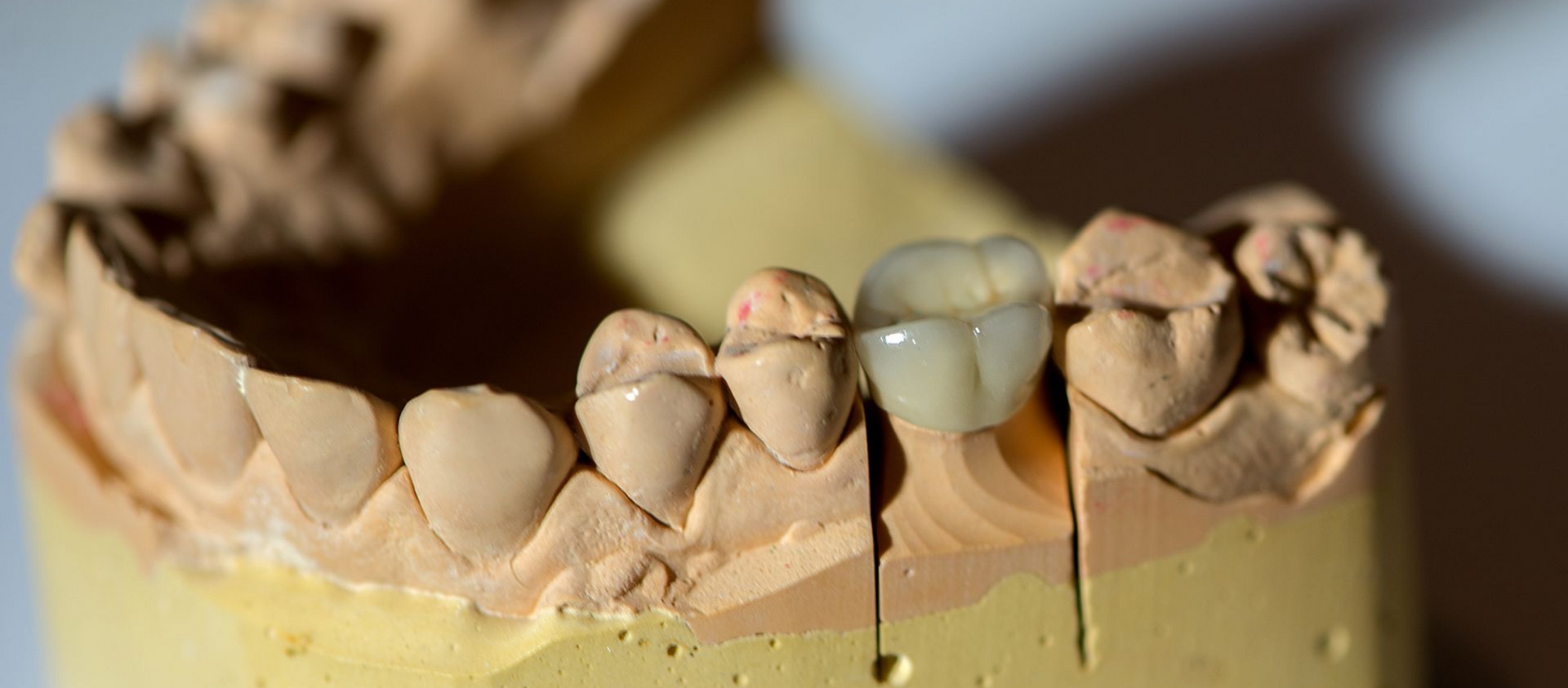 Dental model of teeth with a crown.
