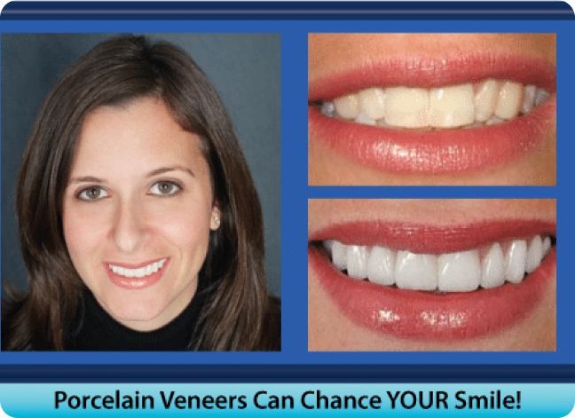 A woman with porcelain veneers on her teeth