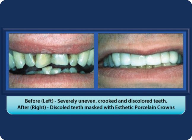 A before and after picture of a person 's teeth