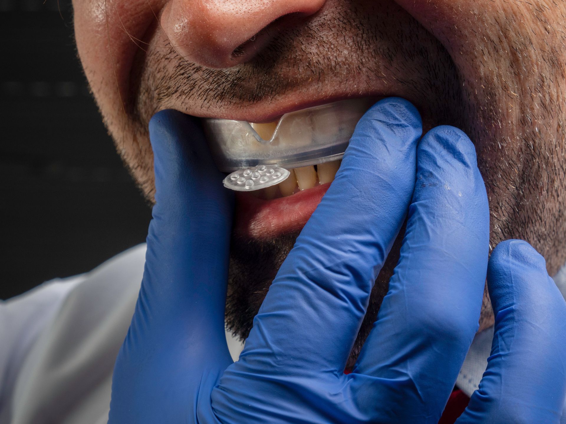 Gloved hands fitting a clear dental aligner onto a person's teeth