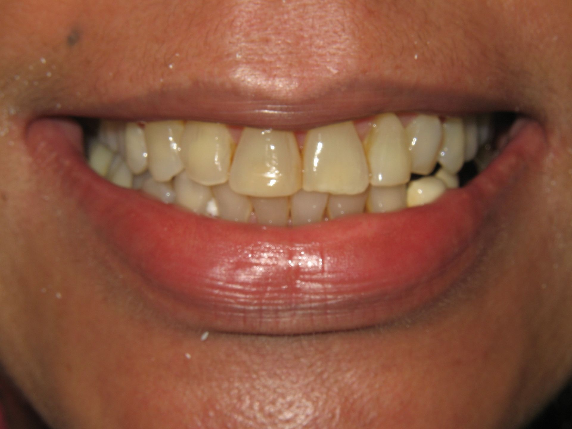 A close up of a person 's teeth with a red lip.