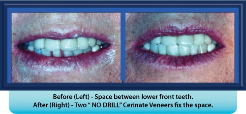 A before and after picture of a person 's teeth