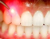A close up of a person 's teeth with a red light shining on them.