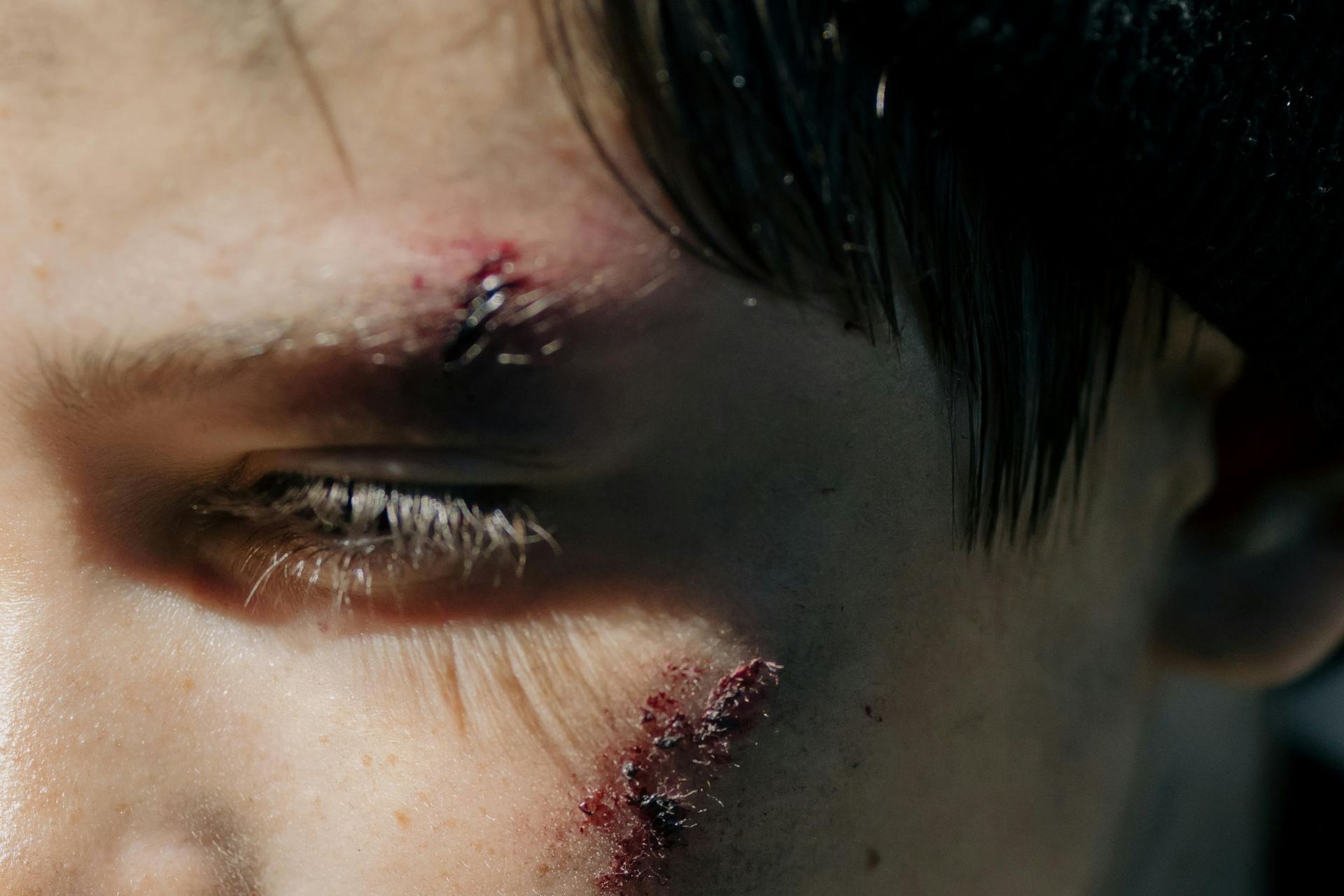 A young boy with a cut on his face.