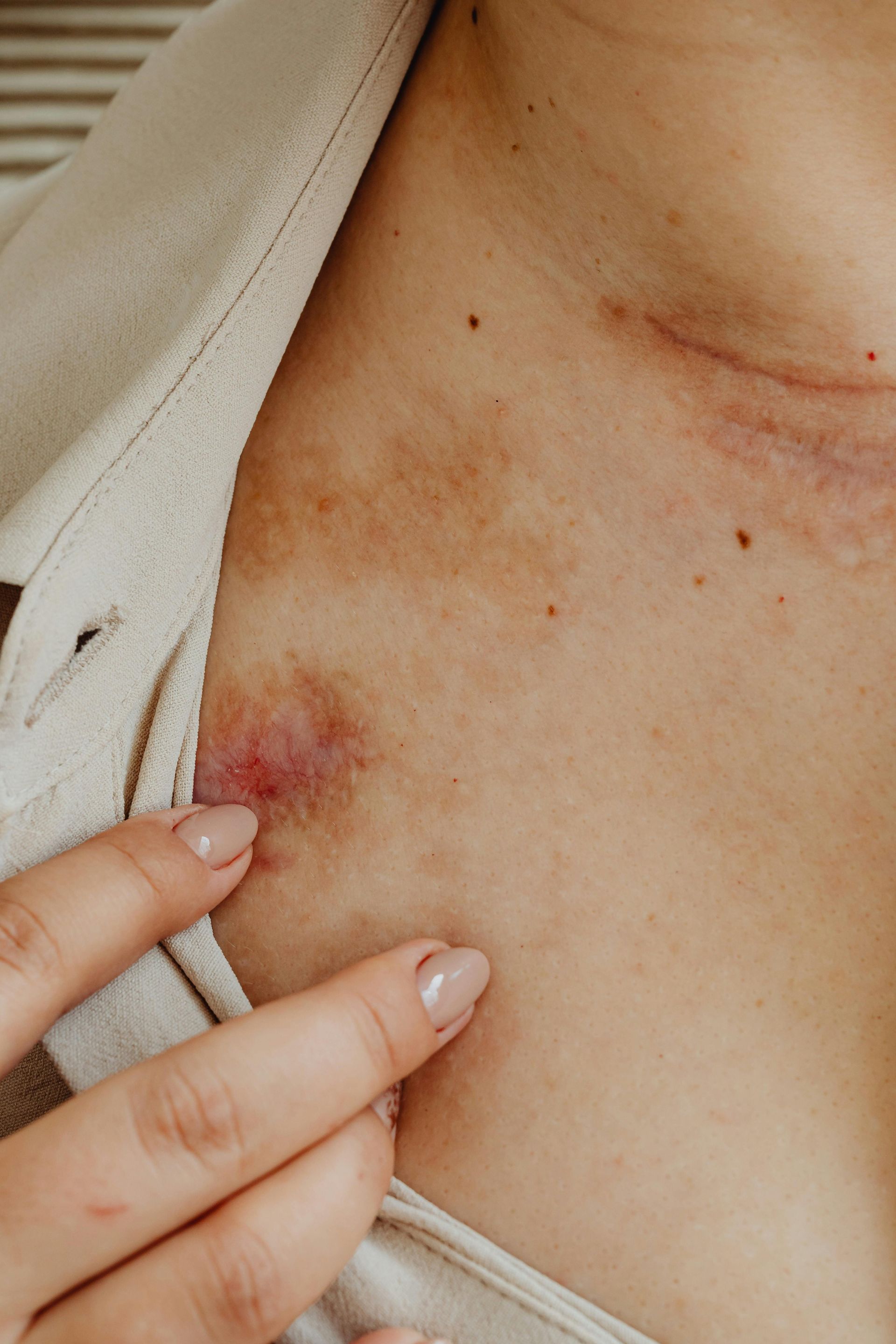 A close up of a person 's chest with a bruise on it.
