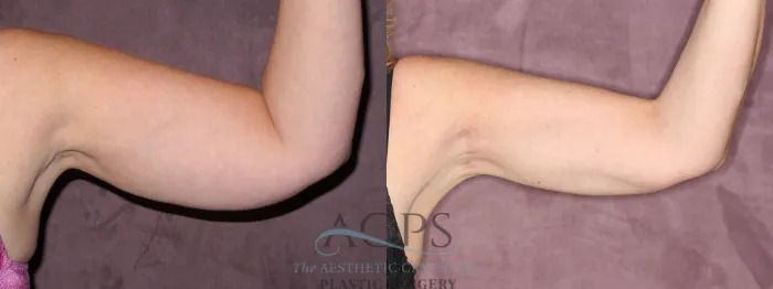 Two bent arms against a pink fabric background, showing flexed elbows and forearms.