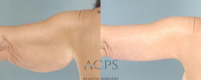 Close-up side view of a nude torso with arm extended, showing the back and shoulder.
