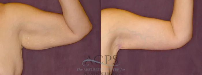 Two flexed arms showing biceps and forearms against a purple background.