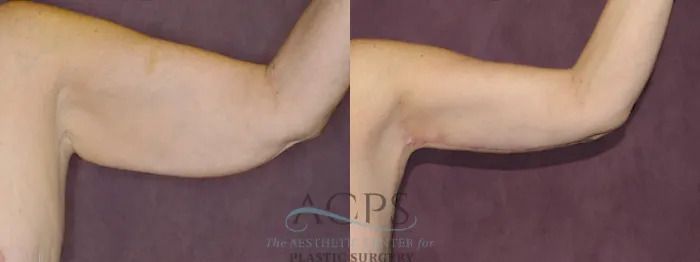 Bent arm with tan skin against a purple background, showing the upper and lower arm bent at the elbow