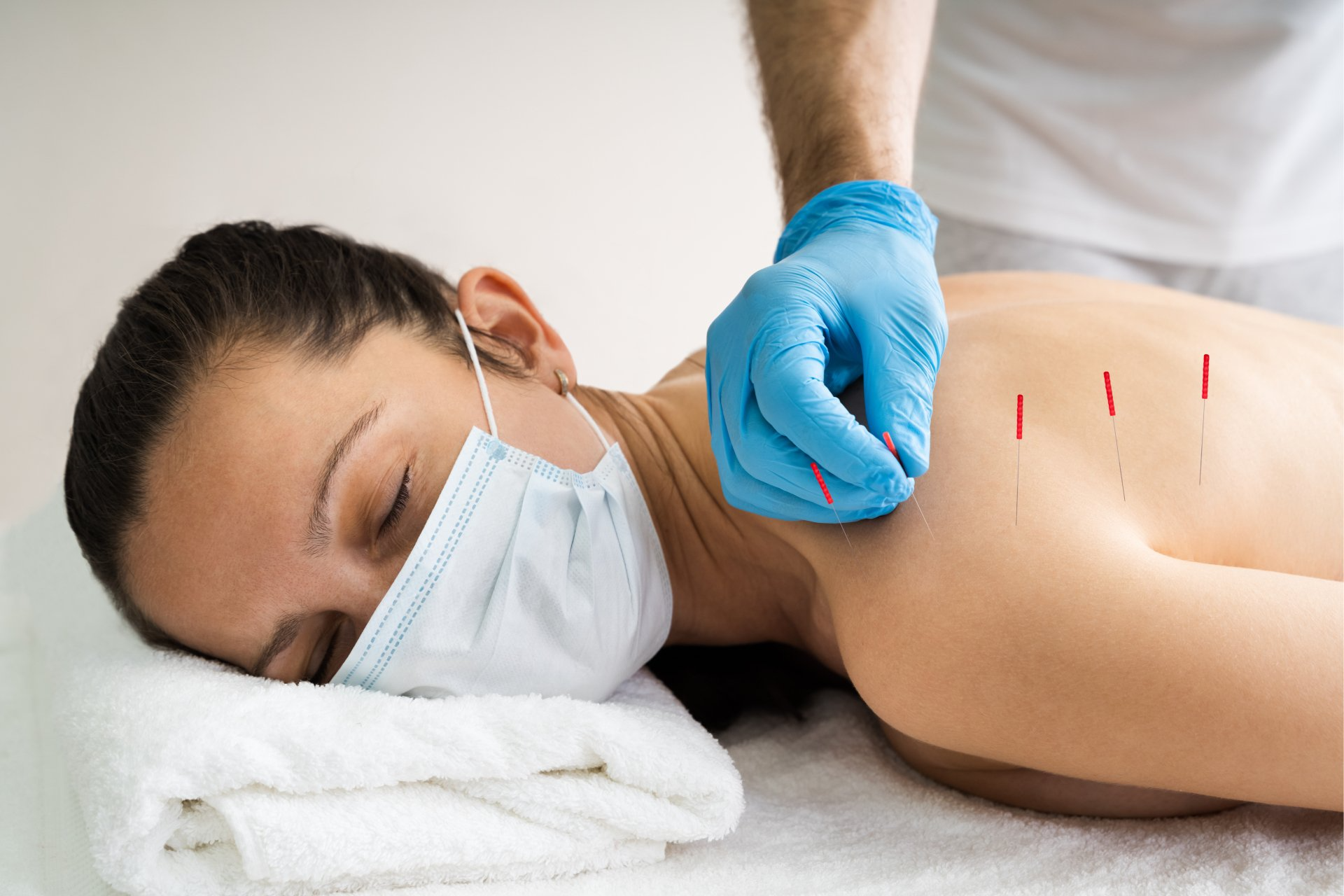 A woman getting acupuncture on her back.