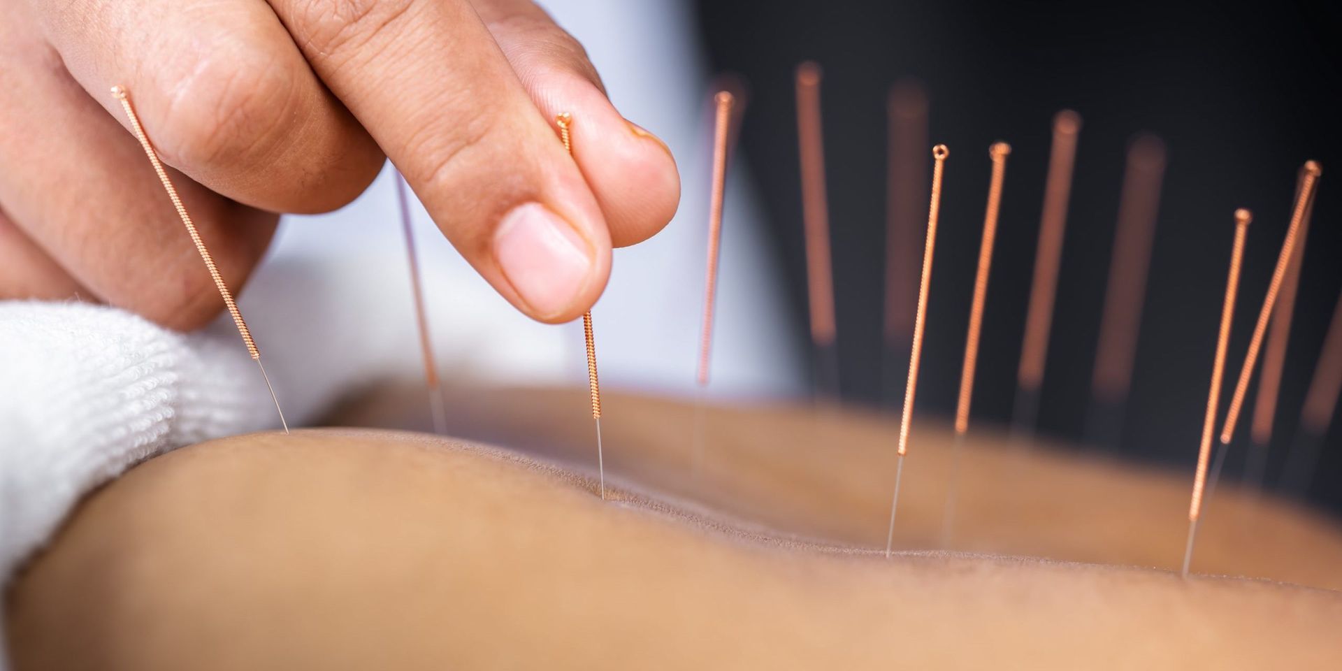 Acupuncture on their back to relieve pain.