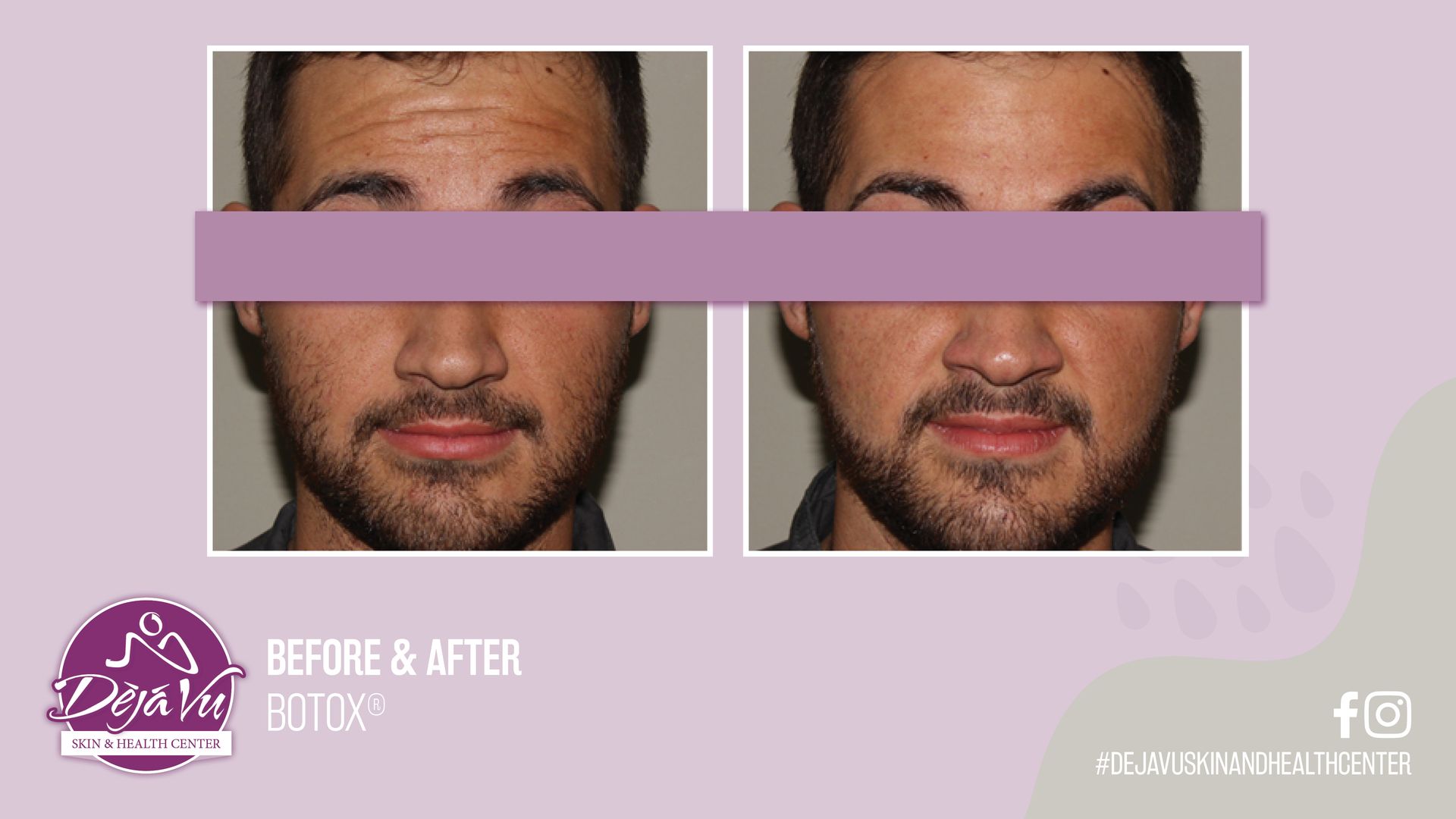 BOTOX® & FILLERS | Deja Vu Skin & Health Center