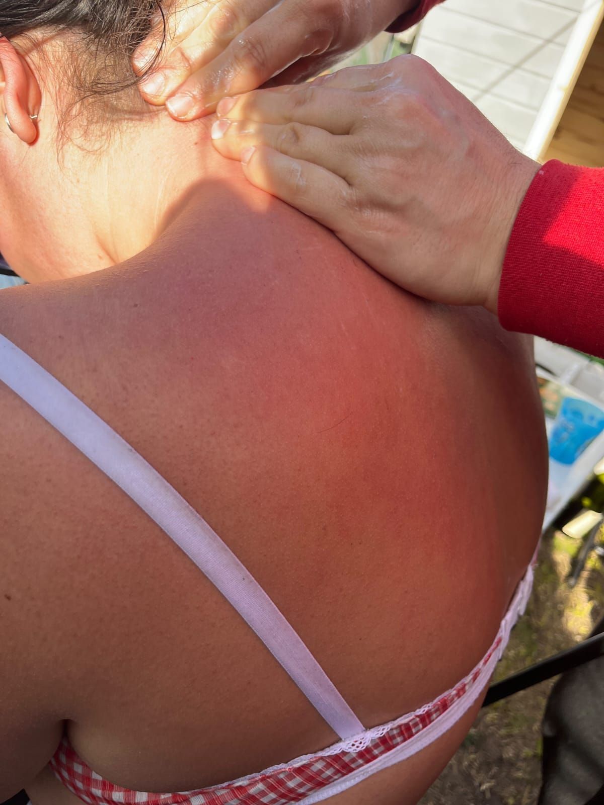 Una mano con una manga roja aplica loción sobre un hombro quemado por el sol
