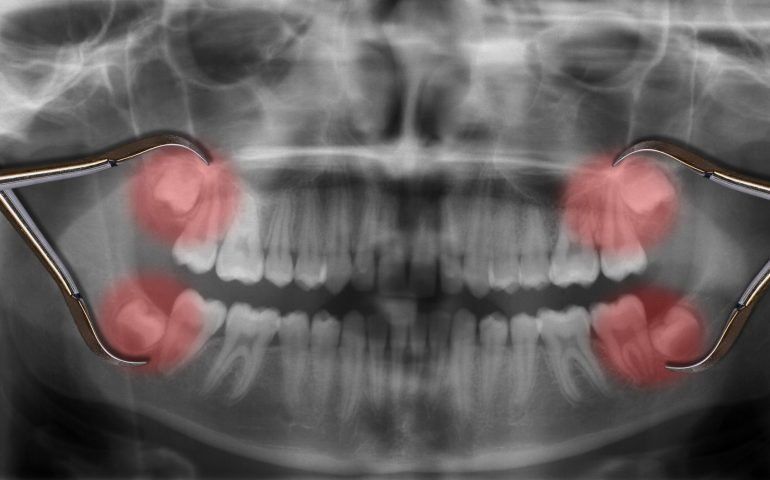 Impacted Tooth Impacted Tooth