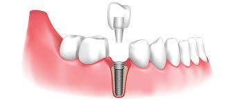 Dental Implants - The Newest and Most Innovative Way to Replace Missing Teeth