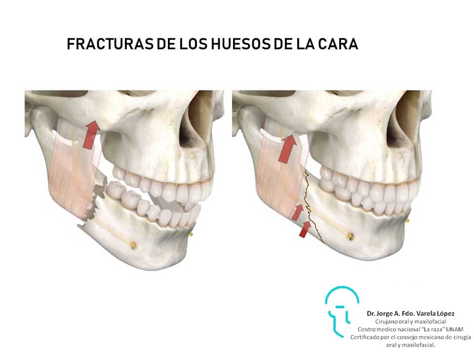 JORGE ALBERTO FERNANDO VARELA LÓPEZ-fracturas de los huesos de la cara