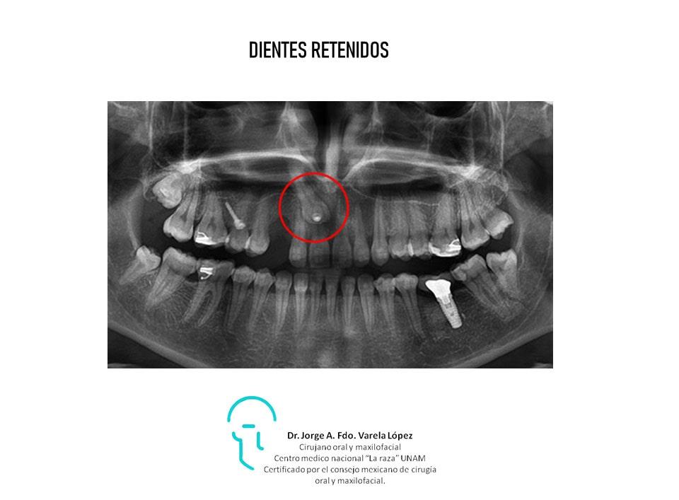 JORGE ALBERTO FERNANDO VARELA LÓPEZ-dientes retenidos