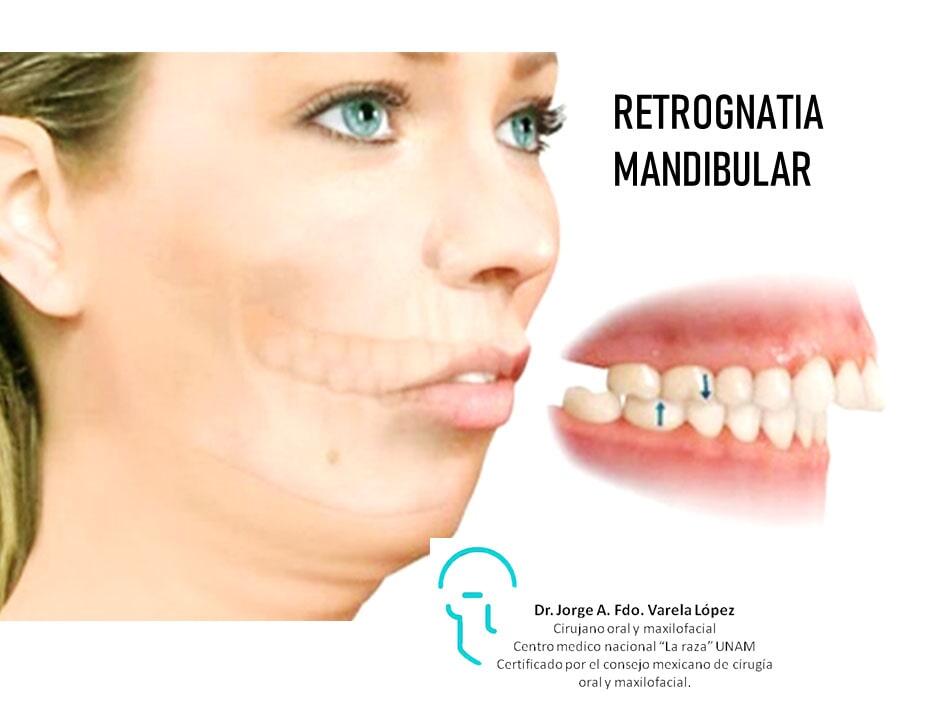 JORGE ALBERTO FERNANDO VARELA LÓPEZ-Retrognatia mandibular