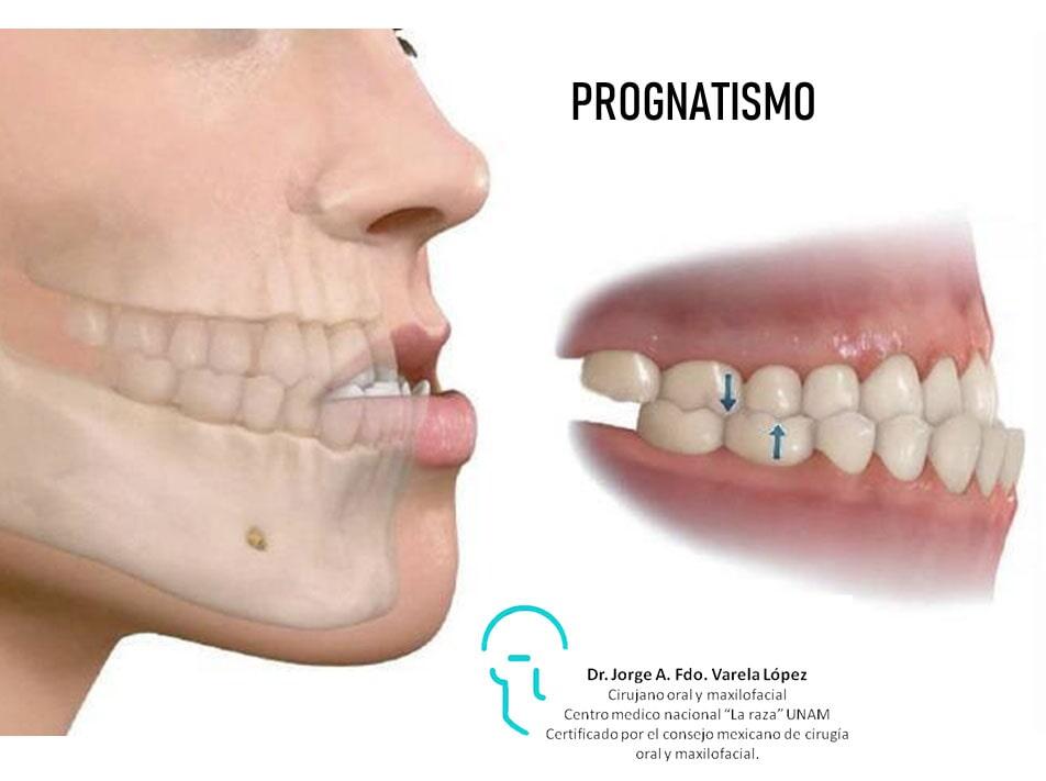 JORGE ALBERTO FERNANDO VARELA LÓPEZ-prognatismo