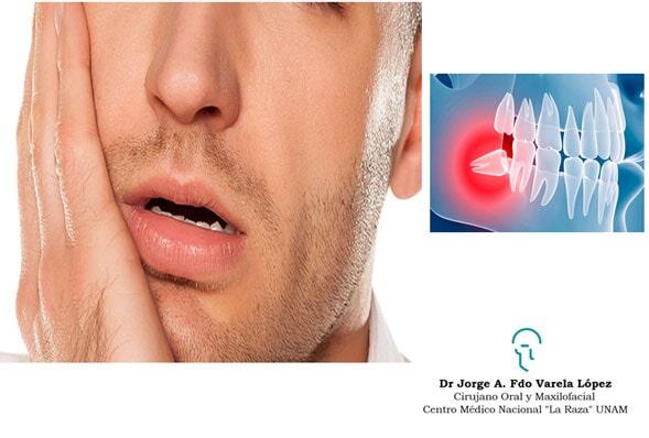 JORGE ALBERTO FERNANDO VARELA LÓPEZ-abseso dental