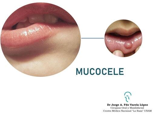 JORGE ALBERTO FERNANDO VARELA LÓPEZ-mucocele