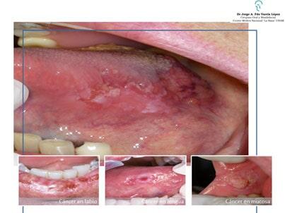 JORGE ALBERTO FERNANDO VARELA LÓPEZ-cáncer oral